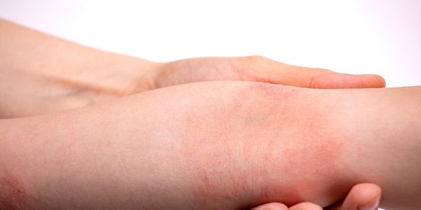 Dermatitis Atópica