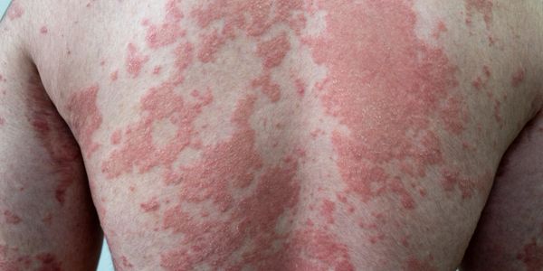 Psoriasis